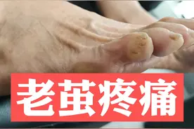 脚上长老茧，疼，为什么，怎么办#dou出新知 #老茧 #脚疼视频封面