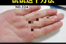 经常#做家务的朋友，手指可能会出现脱皮、干裂得情况。这可能是#角化型湿疹 ，平时尽量不要沾水！#医学科普 #女性 视频封面