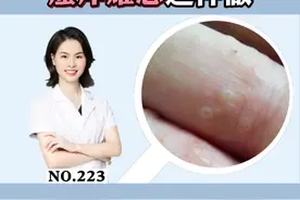 手上长这种小水泡，痒的怀疑人生，试试这个方法帮你解决#科普#汗疱疹#洗发水#家庭主妇 