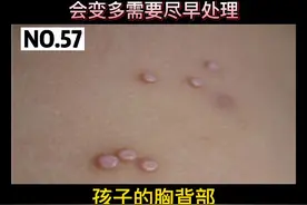 小孩身上出现这种小圆疙瘩，要注意需要及时处理，可能一个发展到多个#科普 #小孩 #皮肤 #传染性软疣 视频封面