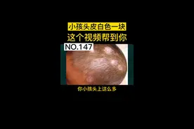 #小孩 头皮有一块块白色的屑状物#头癣 这个视频帮到你#家庭 #宝妈 #育儿视频封面