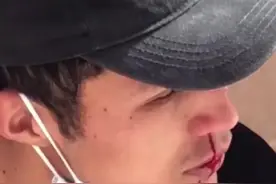 男生中暑，看了一眼美女鼻子流鼻血，网友：原本以为电影中才有的。视频封面