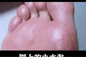 脚上的小水泡，别再用针去刺破了，这样处理#健康#皮肤科#女人   视频封面