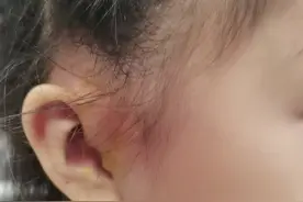生下来的时候，外婆说这个叫聪明洞长大了肯定聪明！爷爷说这个叫耳仓长大后吃穿不愁！今天医生告诉我这个叫耳漏医学上这个属于畸形！#神奇的耳朵 视频封面
