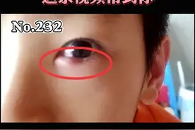 小孩子长针眼是“学坏了”看了不该看的东西吗？长针眼该怎么处理？#眼睛 #小孩 视频封面