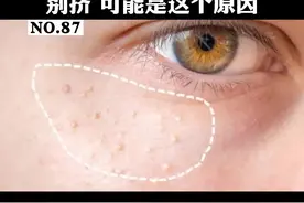 眼睛周围有一些小颗粒，摸起来硬硬的，别再挤了#科普 #脂肪粒 #化妆 视频封面
