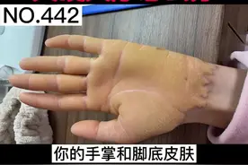 手掌脚掌的皮肤异常增厚，蜡状的外观，还会有裂口，但最痛苦的不是无法根治...#医学科普 #皮肤 #掌跖角化症 视频封面