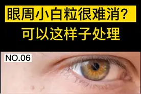 眼睛周围的小白粒，很影响美观，这样子处理#脂肪粒 #皮肤视频封面