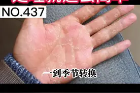 手掌手指反复脱皮，死皮撕不干净，手摸起来很粗糙，教你一个办法解决 #剥脱性角质松解症 #脱皮 #科普 视频封面