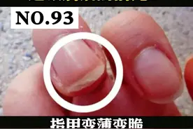 指甲变薄分层，一掰就碎，真的是身体某些疾病有关？#补充维生素 #科普 #指甲 视频封面