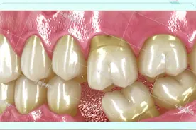 长时间缺牙对周围牙齿的危害你真的了解吗？缺牙要及时修复, 不然后悔就晚了#口腔科普 #关爱牙齿健康 #缺牙视频封面