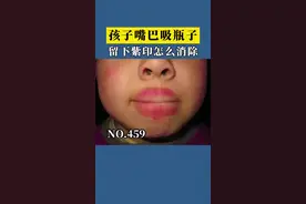 你家小孩会不会也喜欢这么吸瓶子呢，其实这是一个很危险的行为！#小孩子 #医学科普 #紫癜 视频封面