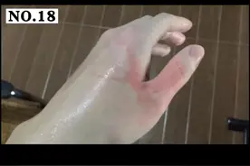 大家日常都会遇到被热水烫伤的情况，这个视频耐心看完，学会处理方法，预防突发情况#烫伤 #烫伤水泡视频封面