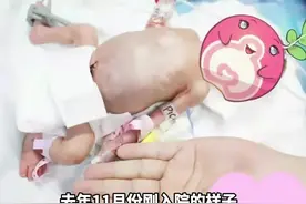 “巴掌宝宝”出院啦！#直播株洲 视频封面
