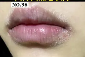 #唇炎 嘴唇红肿脱皮，又痒又痛，喝口水都痛的不行，可以这样处理#科普 #皮肤 视频封面