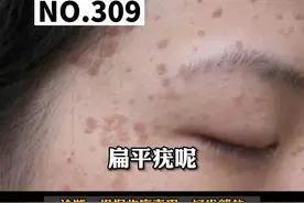 手背，脸上长了扁平丘疹，#扁平疣 不要抠，会越来越多的#皮肤 #科普知识 视频封面