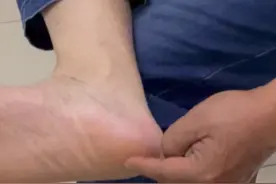 足足底疼痛是为什么#足跟痛#足底筋膜炎#康复训练视频封面