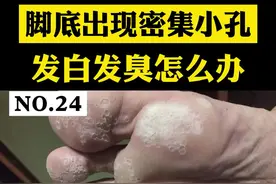 脚底出现密集小孔，发白发臭怎么办？#窝状角质松解症 #脚臭 视频封面