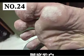 脚底出现密集小孔，发白发臭怎么办？#窝状角质松解症 #脚臭 视频封面