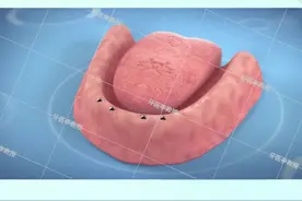 下牙全都掉了，该咋修复？一起看看吧#dou来护牙 #郑州视频封面
