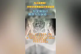 为寻求刺激，29岁小伙将体温计塞进尿道，结果体温计断裂卡在尿道……#人类迷惑行为 视频封面