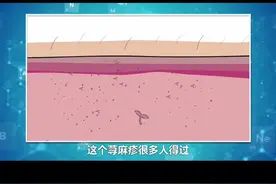 为什么慢性荨麻疹不能治愈，而能够自愈？#宅春节涨知识 #医学科普 #荨麻疹 @DOU+小助手视频封面
