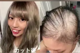 一个多月头发掉光光！#日本女子打莫德纳疫苗后脱发成光头。视频封面