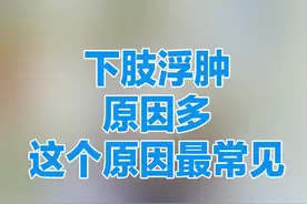 下肢浮肿多为这个原因 #健康  #心脏  #心脏康复视频封面