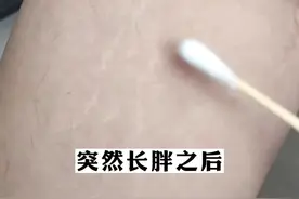 突然长胖后，身上有这种条纹，很难看！教你一个小方法#肥胖纹 #健康 #护肤视频封面