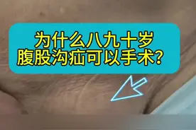 为什么八九十岁的腹股沟疝可以手术？ 腹股沟疝和其他疝不一样，是比较简单的疝气，可以不用大麻醉，可以局麻做腹股沟疝手术，所以，对患者年龄没有特别要求。当然，手术技术也很重要。#腹股沟疝 #脐疝#疝气 #疝气手术视频封面