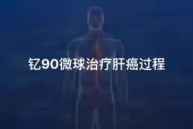 钇90微球治疗肝癌过程#介入手术视频封面