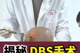离手不离眼，每年具有几百台DBS手术的经验，每一个细节都能看得到完美#专业的事交给专业的团队 #脑起搏器手术苏道庆教授 #传承 #细节决定成败视频封面