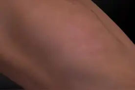 髌骨骨折手术治疗视频封面