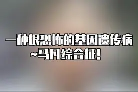 长的太高不一定是好事，有可能是病。#医学科普 #马凡综合征 #身高 #医生日常 #生长发育视频封面
