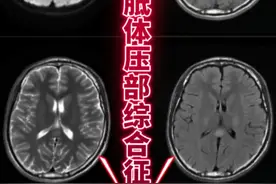 可逆性胼胝体压部病变综合征#医学影像  #核磁共振 #病例视频封面