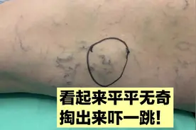 大腿上多发肿物，掏出来吓一跳，全是金灿灿的疙瘩！#脂肪瘤视频封面