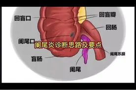 阑尾如何寻找以及阑尾炎如何诊断，听听宋医生的方法适不适合你 #阑尾炎视频封面