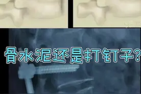 #脊柱健康 #骨水泥 老年人由于骨质疏松，一旦发生骨折，好多被告知要打骨水泥，有的需要打钉子，简单区别是什么呢？#内固定 #骨折视频封面