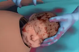 女人剖腹产要经历七层之痛，科普的全程过程。视频封面
