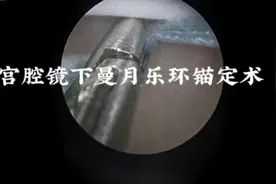 子宫腺肌症患者的子宫比较大，上曼月乐环容易脱落视频封面