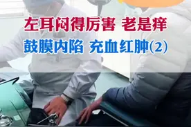 (2)左耳闷得厉害 老是痒，鼓膜内陷 充血红肿。#耳闷  #耳朵痒了怎么办  #咽鼓管功能障碍  #咽鼓管球囊扩张  #耳鼻喉刘军视频封面