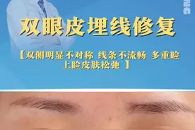 #埋线双皮眼 修复 不适当的埋线会有很多后顾之忧#双眼皮修复 #眼修复医生陈勇 #医学科普视频封面