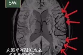 不对称皮质静脉征（提示低灌注） #医学影像 #磁共振 #磁敏感加权成像 #低灌注视频封面