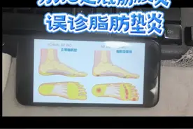 别把足底筋膜炎误诊脂肪垫炎 #硬核健康科普行动 跟大家探讨下： 别把足底筋膜炎 误诊脂肪垫炎#足底筋膜炎 #足底按摩 #疼痛 #脂肪视频封面