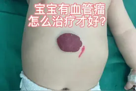 #医学科普 #血管瘤 #河南省儿童医院 #dou来关爱儿童健康视频封面