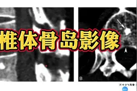椎体骨岛影像表现，简单易懂的影像知识，收藏学习！视频封面