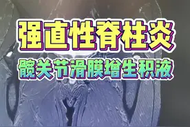 强直性脊柱炎，髋关节滑膜增生积液，治疗宜强 #强直性脊柱炎 #髋关节 视频封面