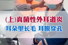 真菌性外耳道炎，耳朵里面长毛，耳膜穿孔怎么治疗？#真菌性外耳道炎 #中耳炎  #真菌感染 #耳膜穿孔 #耳鼻喉刘军视频封面