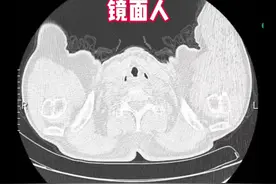 偶遇镜面人，学习了解一下哈~#镜面人 #医学影像 #医生日常 #医学科普视频封面