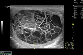 睾丸及附睾结核（Testicular and Epididymal Tuberculosis）是男性生殖系统结核的主要表现形式，多继发于泌尿系统结核（如肾结核）或全身播散性结核。   超声表现: 1. 附睾结核（通常先受累）   早期:附睾尾部局限性肿大，呈低回声结节，边界不清。血流信号可增多（炎症期）。   进展期： 病变扩大，回声不均，可见干酪样坏死（无回声区）或钙化（强回声伴声影）。 形成冷脓肿时，表现为不规则无回声区，内可见碎屑样回声。   慢性期： 纤维化、钙化增多，血流减少。 可形成窦道，表现为低回声条索状结构延伸至阴囊壁。   2. 睾丸结核（多由附睾结核蔓延而来）   局灶性病变：低回声结节，边界不清，内部回声不均（坏死、钙化）。   弥漫性病变： 睾丸弥漫性肿大，结构破坏，呈“虫蚀样”或“网格样”改变（干酪坏死+纤维化）。    严重者可形成睾丸脓肿（无回声区伴分隔）。   钙化: 点状、斑片状强回声，后方伴声影（慢性期特征）。视频封面